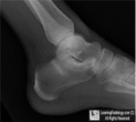 Calcaneal Stress Fracture